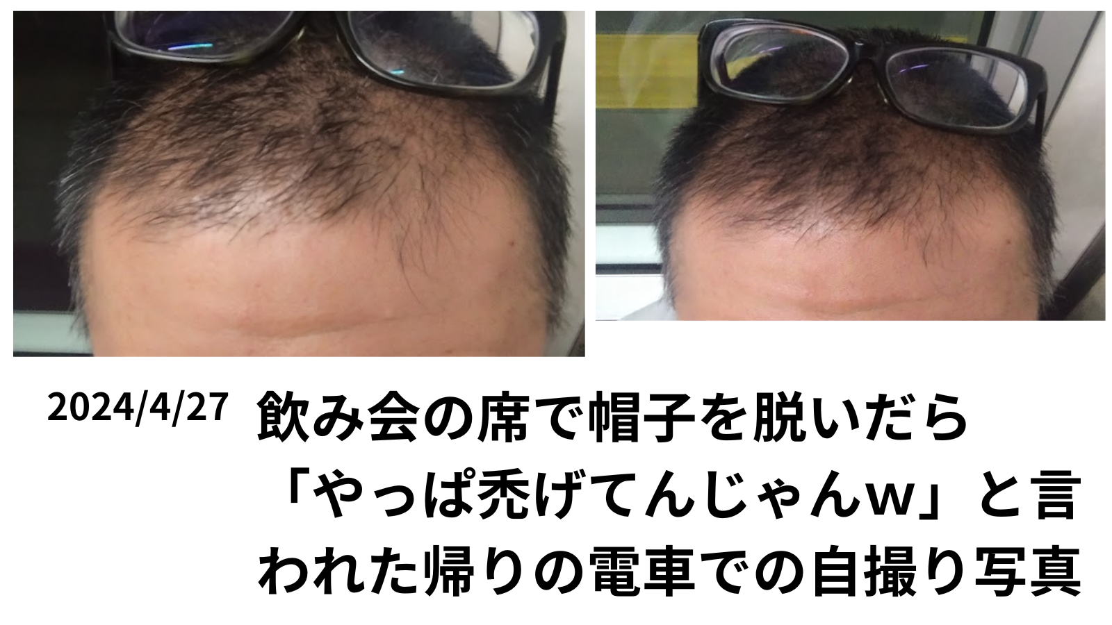 禿げから逃げない そう決めた日 AGA治療開始4か月前