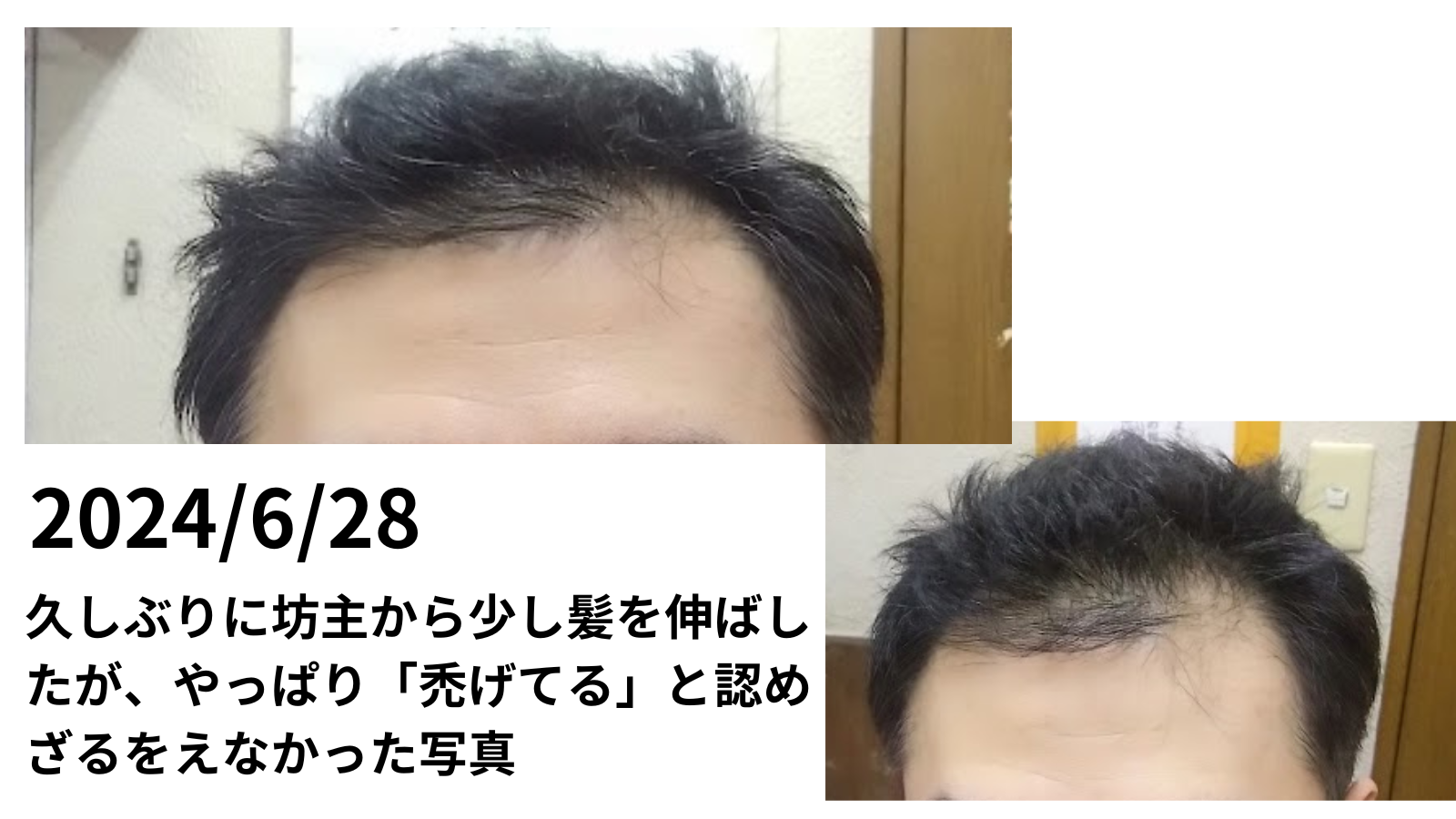虚しい抵抗 髪を伸ばしてもハゲはハゲだった