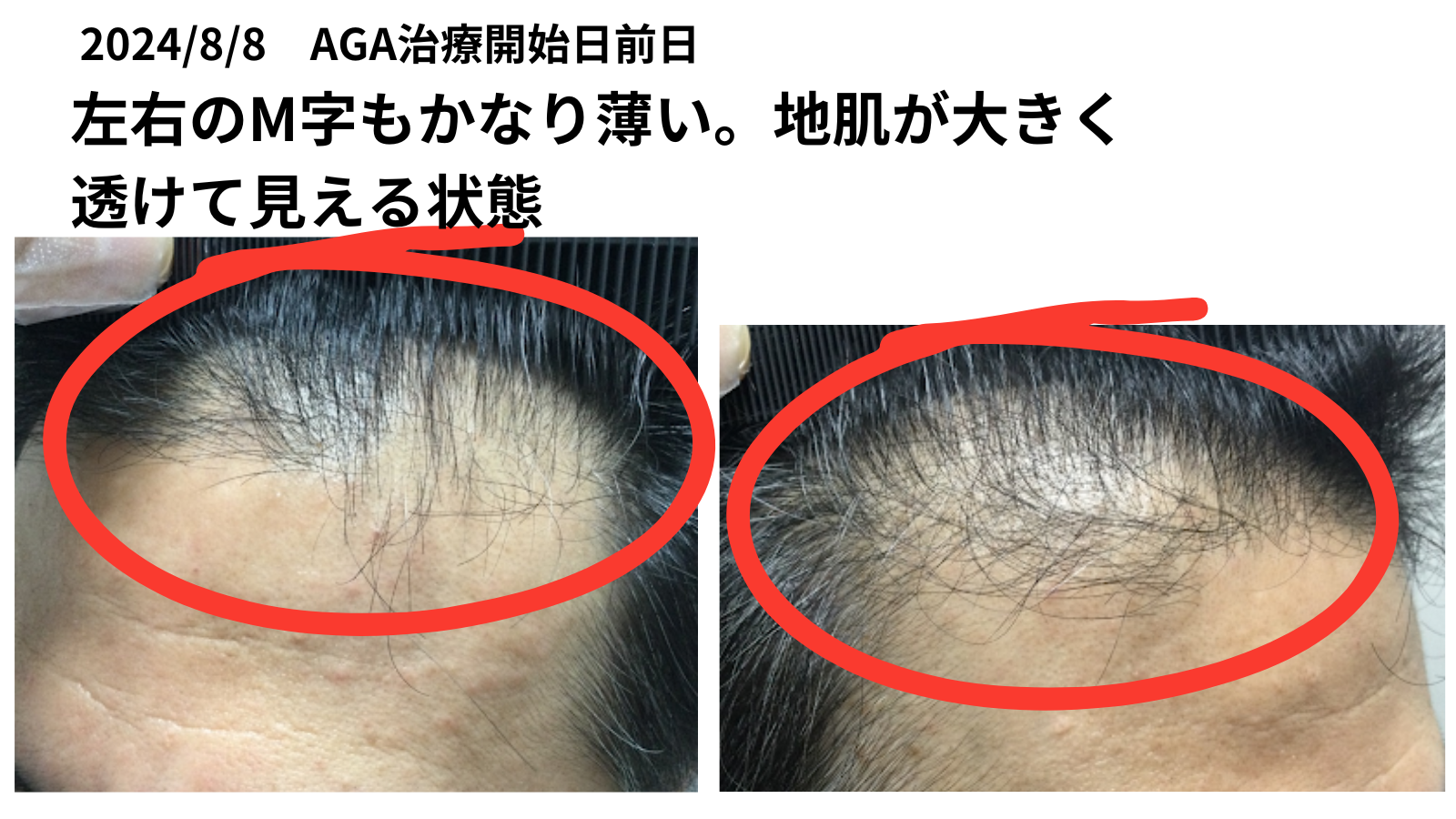 決戦前夜 AGA治療スタート➁