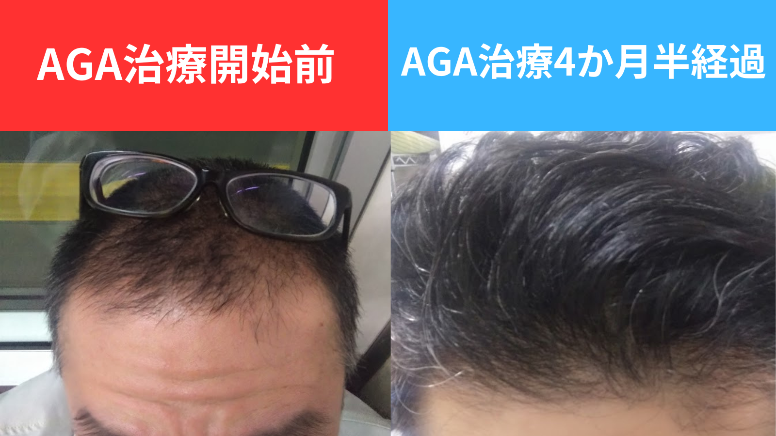 大丈夫、男性はほぼほぼハゲるんです